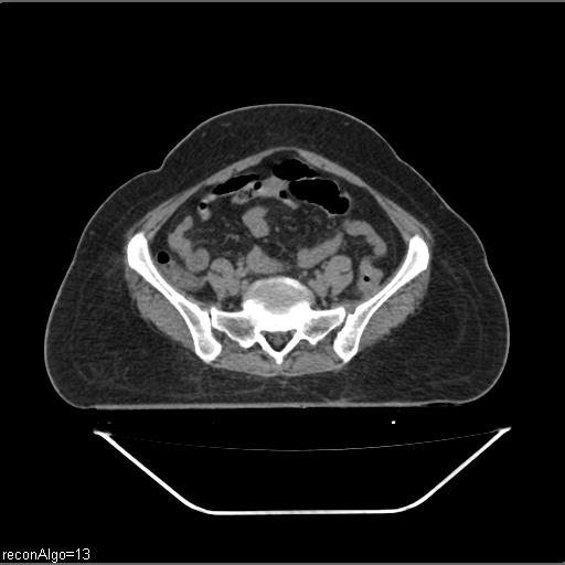 Carcinoma cervix- brachytherapy applicator (Radiopaedia 33135-34173 Axial non-contrast 6).jpg