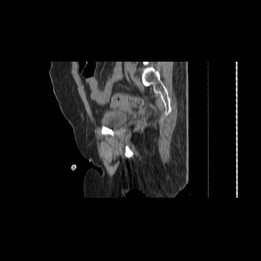 File:Carcinoma cervix- brachytherapy applicator (Radiopaedia 33135-34173 D 127).jpg