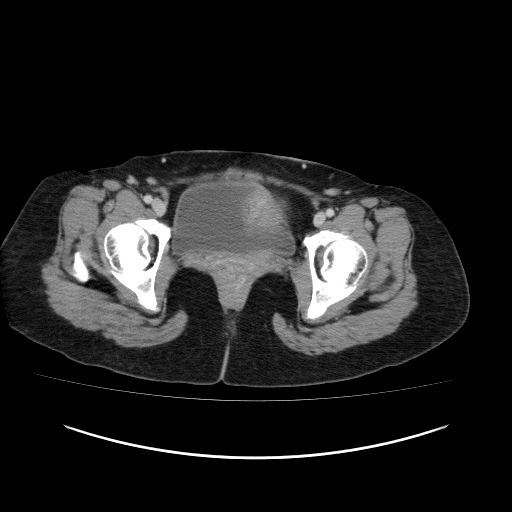 Carcinoma colon - hepatic flexure (Radiopaedia 19461-19493 A 123).jpg