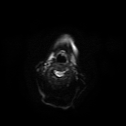 Carcinoma ex-pleomorphic adenoma of parotid (Radiopaedia 28383-28627 Ax DWI B-500 GE 6).jpg