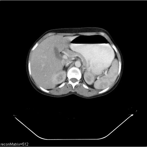 File:Carcinoma of esophagus (Radiopaedia 27356-27550 A 1).jpg