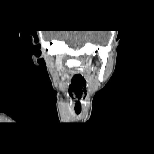 Carcinoma of the maxillary antrum (Radiopaedia 53805-59888 Coronal C+ delayed 94).jpg