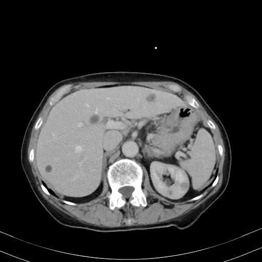Carcinosarcoma (Radiopaedia 70401-80503 A 17).jpg
