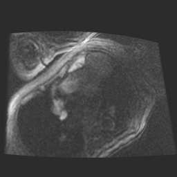 File:Cardiac fibroma (Radiopaedia 38974-41150 4 chamber FGRET 25).jpg