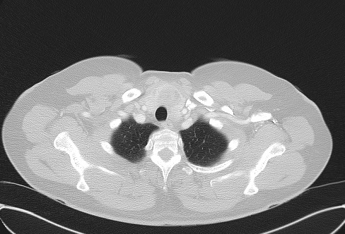 Cardiac sarcoidosis (Radiopaedia 74548-85534 Axial lung window 8).jpg