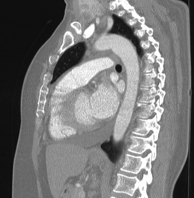 Cardiac sarcoidosis (Radiopaedia 74548-85534 Sagittal lung window 40).jpg