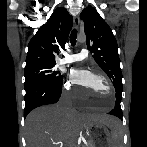 Cardiac tumor - undifferentiated pleomorphic sarcoma (Radiopaedia 45844-50134 Coronal non-contrast 32).png