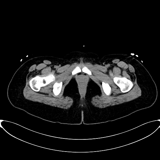 Caroli disease with medullary sponge kidney (Radiopaedia 82622-96804 Axial non-contrast 78).jpg
