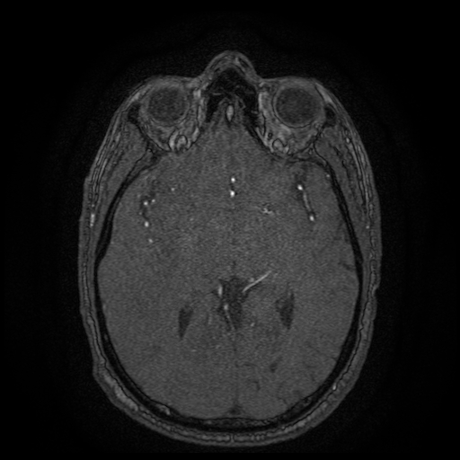 File:Carotid arterial dissection with acute cerebral infarction (Radiopaedia 26636-26784 MRA 86).jpg