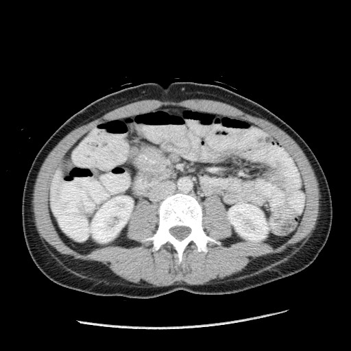 File:Castleman disease with fibrous pseudotumor in the abdomen (Radiopaedia 77296-89373 A 65).jpg