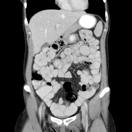 Castleman disease with fibrous pseudotumor in the abdomen (Radiopaedia 77296-89373 B 30).jpg