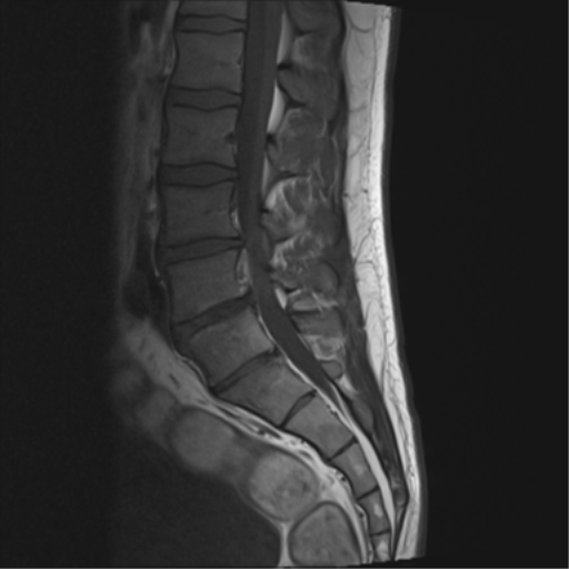 File:Cauda equina syndrome (Radiopaedia 53615-59672 Axial T1 9).png