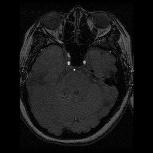 Cavernoma, DVA and right ICA aneurysm (Radiopaedia 33890-35072 E 68).png