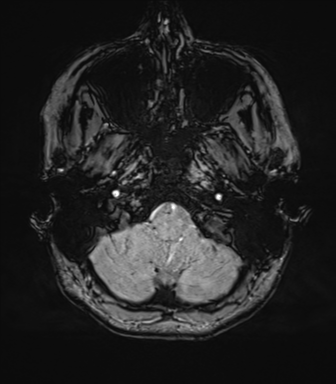File:Cavernoma with bleed - midbrain (Radiopaedia 54546-60773 Axial SWI 8).png