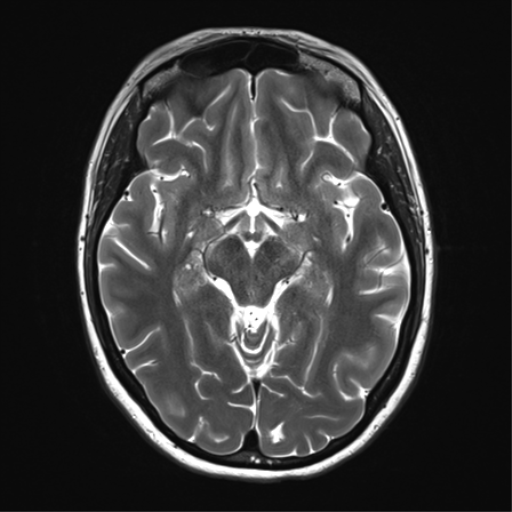 File:Cavernoma with bleed - midbrain (Radiopaedia 54546-60773 Axial T2 17).png