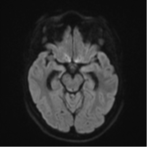 File:Cavernoma with bleed - midbrain (Radiopaedia 54546-60774 Axial DWI 38).png