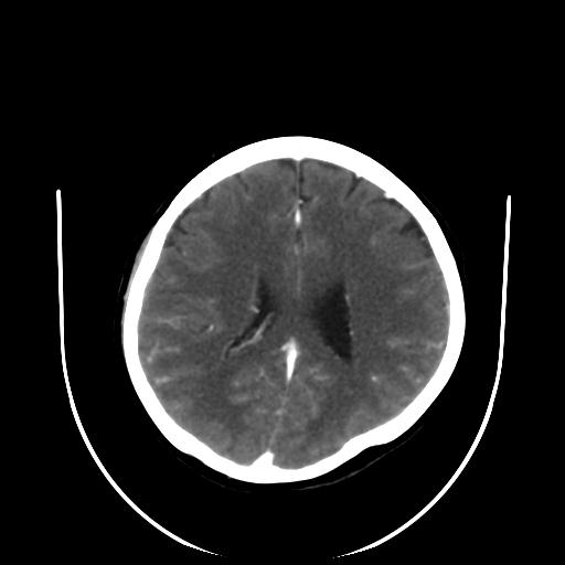 File:Cavernoma with developmental venous anomaly (Radiopaedia 22470-22506 C+ arterial phase 23).jpg