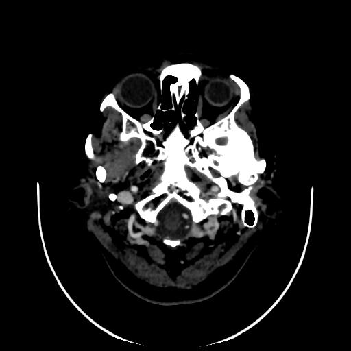 Cavernoma with developmental venous anomaly (Radiopaedia 22470-22506 C 1).jpg
