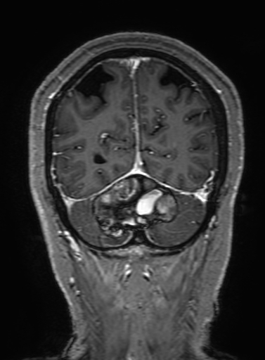 Cavernous hemangioma of the cerebellar falx (Radiopaedia 73025-83724 Coronal T1 C+ 309).jpg