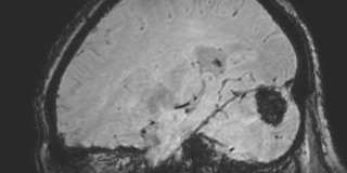 File:Cavernous hemangioma of the cerebellar falx (Radiopaedia 73025-83724 Sagittal BOLD 137).jpg