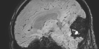 File:Cavernous hemangioma of the cerebellar falx (Radiopaedia 73025-83724 Sagittal BOLD 90).jpg