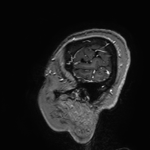 File:Cavernous hemangioma of the cerebellar falx (Radiopaedia 73025-83724 Sagittal T1 C+ 194).jpg