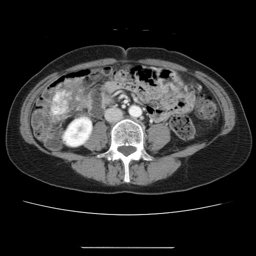File:Cavernous hepatic hemangioma (Radiopaedia 75441-86667 B 65).jpg