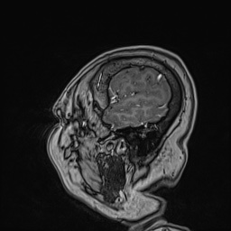 Cavernous sinus meningioma (Radiopaedia 63682-72367 Sagittal T1 C+ 147).jpg