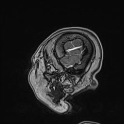 Cavernous sinus meningioma (Radiopaedia 63682-72367 Sagittal T1 C+ 152).jpg