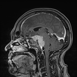 Cavernous sinus meningioma (Radiopaedia 63682-72367 Sagittal T1 C+ 90).jpg