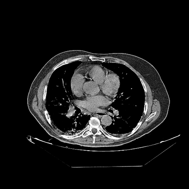 Cavitating bronchogenic carcinoma (Radiopaedia 44489-48162 Axial non-contrast 48).jpg