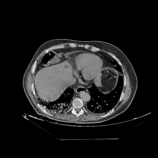 Cavitating bronchogenic carcinoma (Radiopaedia 44489-48162 Axial non-contrast 66).jpg
