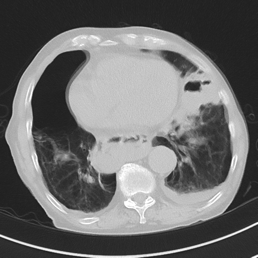 Cavitating pneumonia - lingular segments (Radiopaedia 34386-35678 Axial lung window 43).png