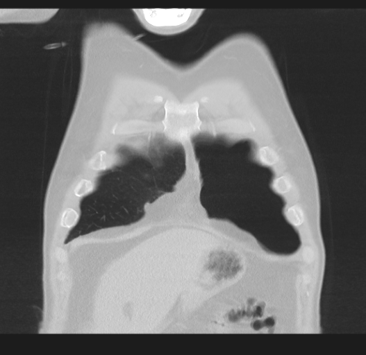 Cavitating pneumonia complicated by pneumothorax (Radiopaedia 48149-52994 Coronal lung window 10).png