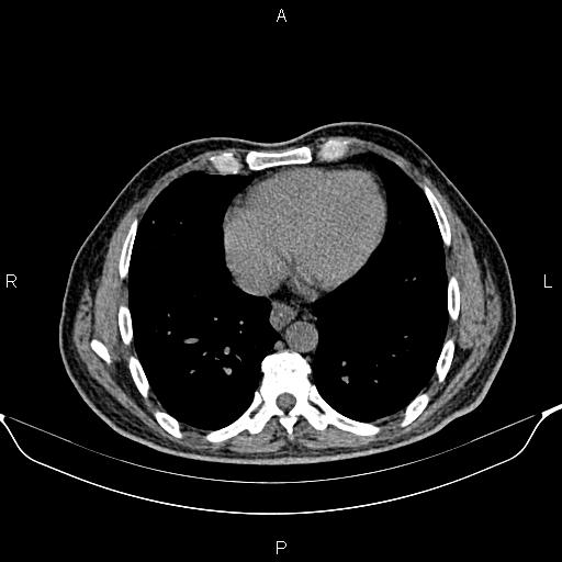 Cecal adenocarcinoma (Radiopaedia 85324-100916 Axial non-contrast 3).jpg