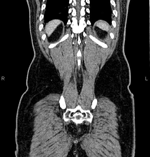 Cecal adenocarcinoma (Radiopaedia 85324-100916 D 61).jpg