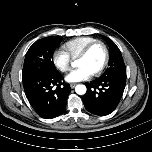File:Cecal cancer with appendiceal mucocele (Radiopaedia 91080-108651 A 42).jpg