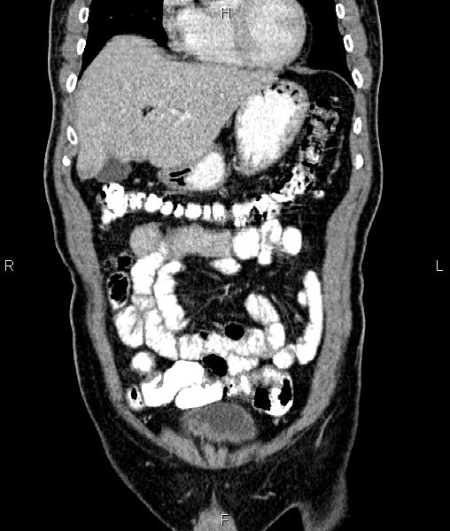 Cecal cancer with appendiceal mucocele (Radiopaedia 91080-108651 D 18).jpg