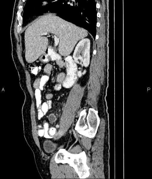 File:Cecal cancer with appendiceal mucocele (Radiopaedia 91080-108651 E 34).jpg