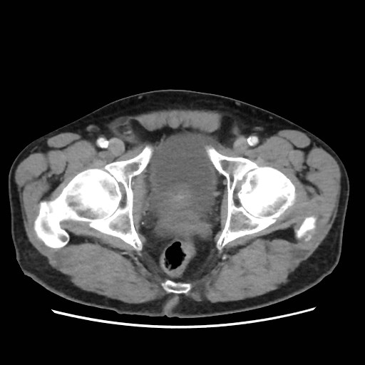 File:Cecal mass causing appendicitis (Radiopaedia 59207-66531 A 84).jpg