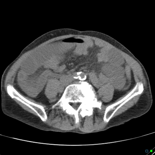 Cecal volvulus - atypical (Radiopaedia 21637-21588 non-contrast 45).jpg