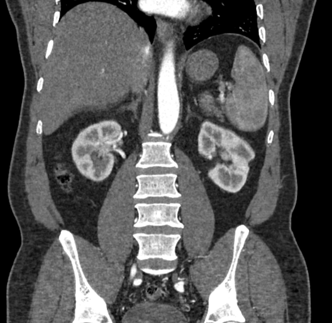 Celiac artery dissection (Radiopaedia 52194-58080 C 90).jpg