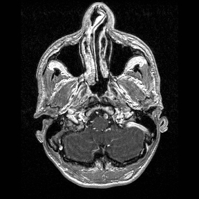 Central-variant posterior reversible encephalopathy syndrome (PRES) (Radiopaedia 43880-47358 Axial T1 C+ 12).jpg