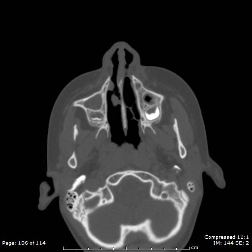 File:Central giant cell granuloma (Radiopaedia 45612-49754 Axial bone window 53).jpg