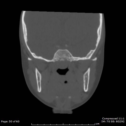 File:Central giant cell granuloma (Radiopaedia 45612-49754 Coronal bone window 50).jpg