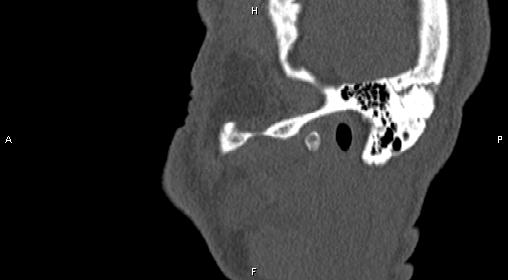 File:Central giant cell granuloma (Radiopaedia 83346-97761 Sagittal bone window 4).jpg
