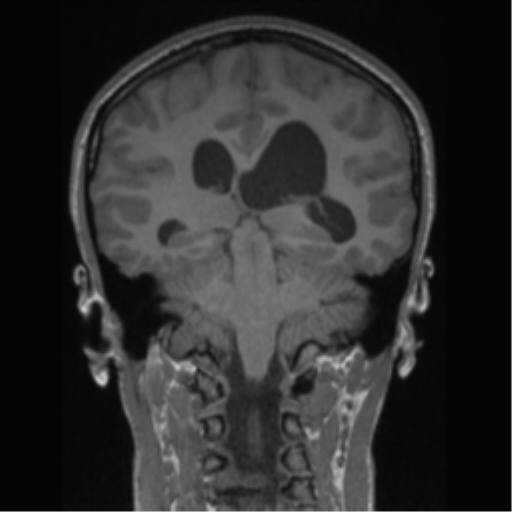 Central neurocytoma (Radiopaedia 37664-39557 Coronal T1 36).png