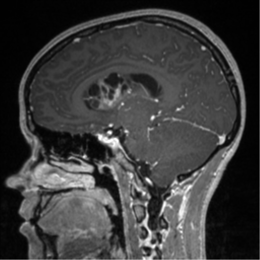 File:Central neurocytoma (Radiopaedia 37664-39557 Sagittal T1 C+ 55).png