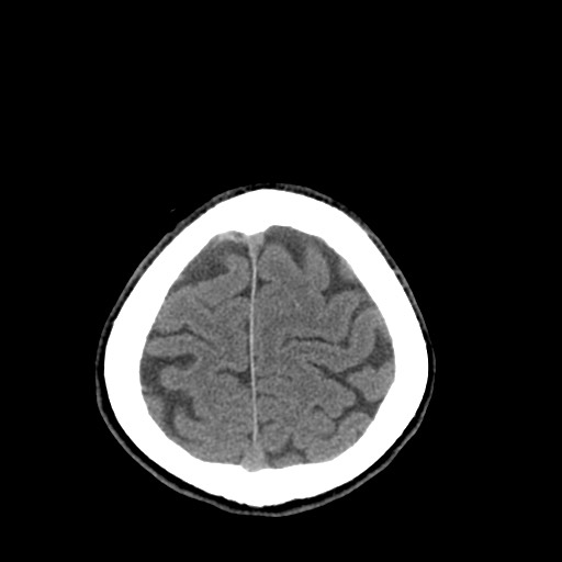 Central neurocytoma (Radiopaedia 68725-78432 Axial non-contrast 47).jpg