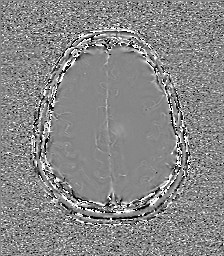 Central neurocytoma (Radiopaedia 84497-99872 Axial 55).jpg